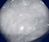 flat polyp seen with white light flat polyp seen with white light